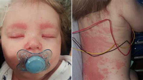 meningitis in toddlers rash